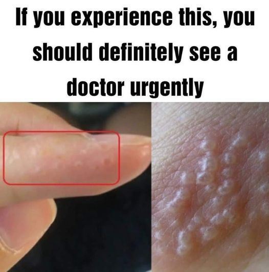 If you see these painful red bumps, you may have dyshidrotic eczema