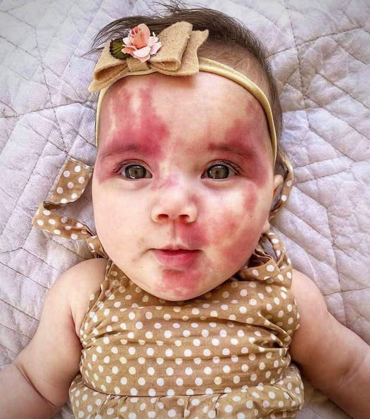 Mom paints face to match daughter’s port wine birthmark